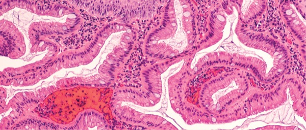 Endoscopic Assessment of Reflux