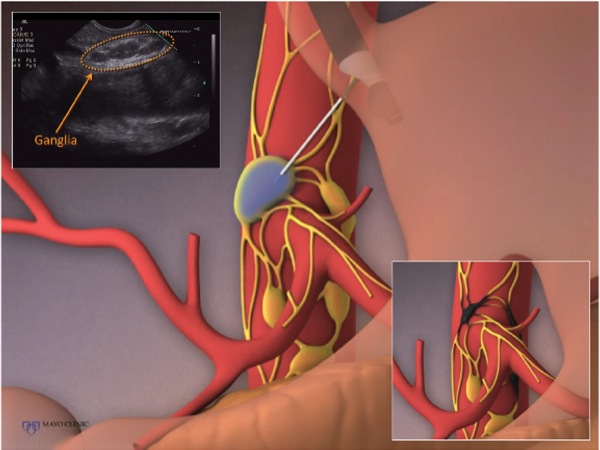 The Frontiers of Therapeutic Endoscopic Ultrasound