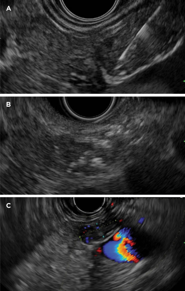 The Frontiers of Therapeutic Endoscopic Ultrasound