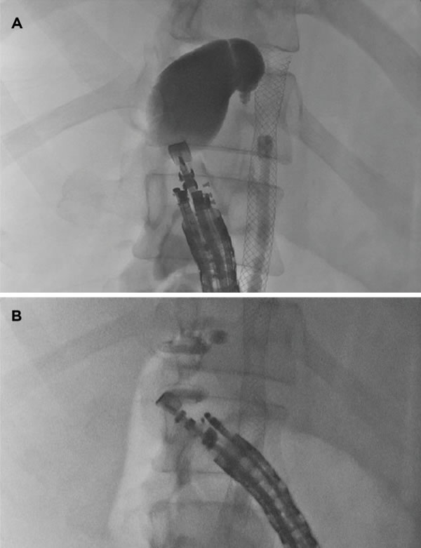 The Frontiers of Therapeutic Endoscopic Ultrasound