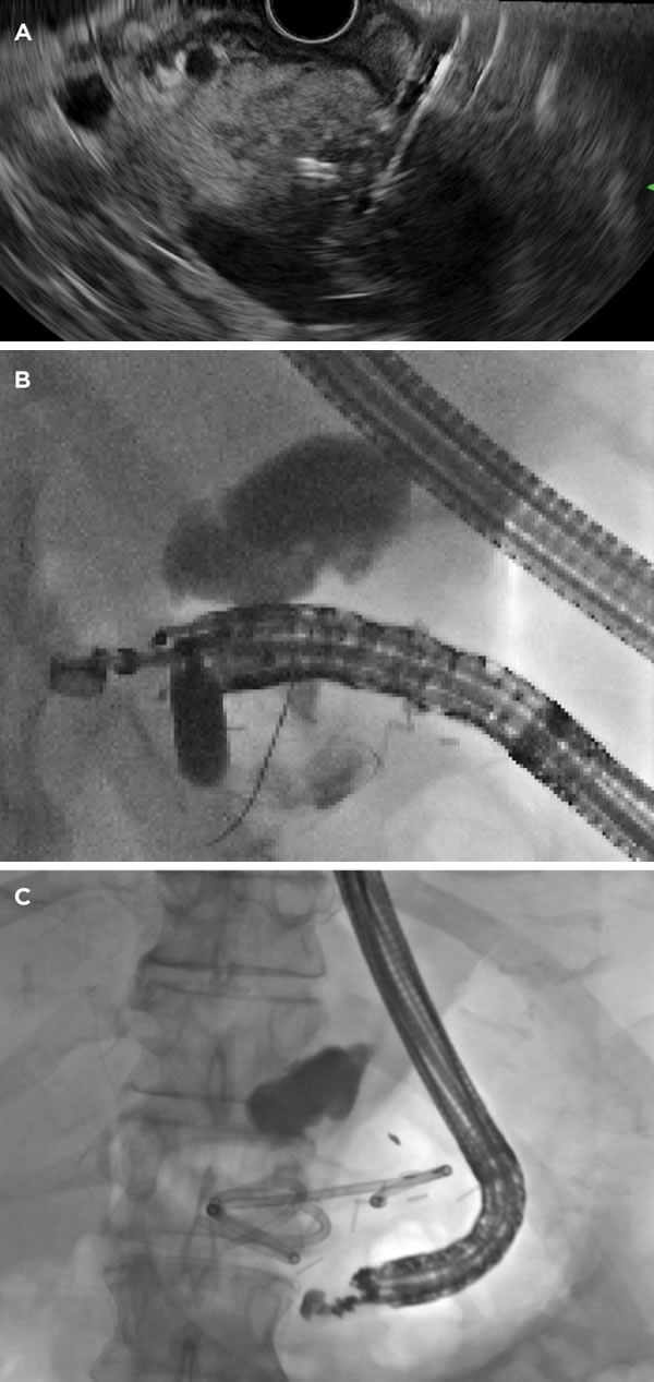 The Frontiers of Therapeutic Endoscopic Ultrasound