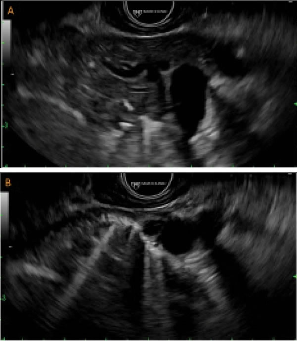 The Frontiers of Therapeutic Endoscopic Ultrasound